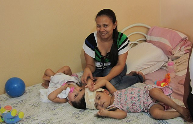 15 часов разделяли сиамских близнецов из Бразилии