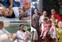 15 часов разделяли сиамских близнецов из Бразилии