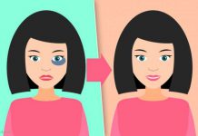 Простые способы быстро убрать синяк